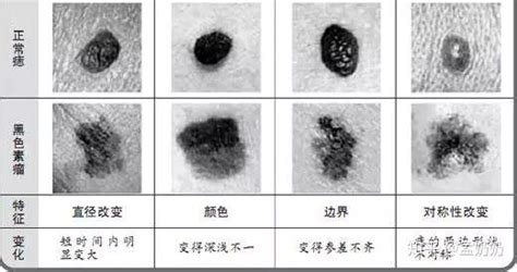 黑痣凸起|黑痣凸起就一定是黑色素瘤吗？